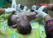 (Video) Warga Lampung Timur Lahirkan Bayi Kembar Siam Dempet Tulang Belakang